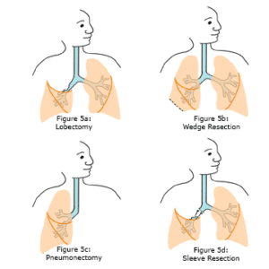 Surgery for Lung Cancer Patients | Lung Cancer