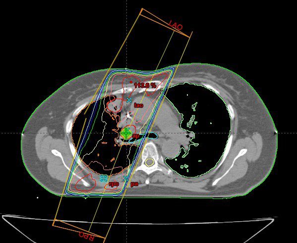 Radiation Therapy for Non-Small Cell Lung Cancer | Caring Ambassadors